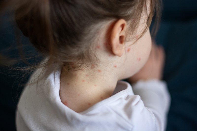Measles in Kids Explained by 365 Wellness Featured